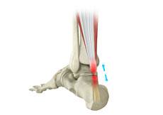 Achilles Tendon Repair