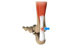 Achilles Tendon Rupture