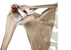 Acromioclavicular Joint Injuries