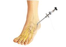 Ankle Arthroscopy