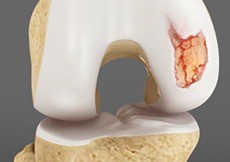 Articular Cartilage Injury