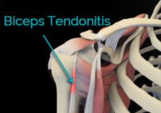 Biceps Tendinitis