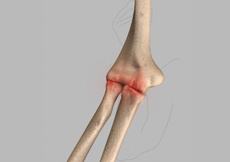 Elbow Arthritis