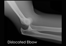 Elbow Dislocation