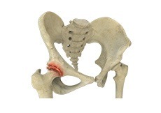 Hip Arthritis