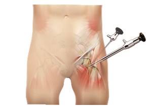 Hip Arthroscopy