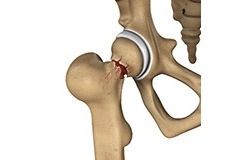 Hip Injury