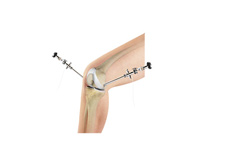 Knee Arthroscopy