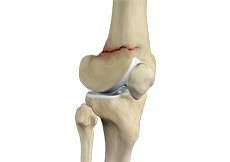 Knee Fracture