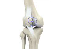 Patellar Instability