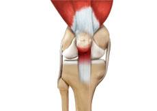 Patellar Tendinitis