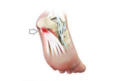 Plantar Fasciitis