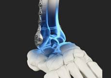 Syndesmosis Surgery Without the Tightrope