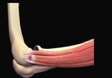 Tennis Elbow Surgery