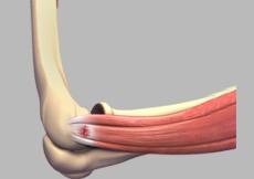 Tennis Elbow