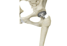 Total Hip Replacement 