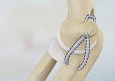Ulnar Collateral Ligament Reconstruction/Tommy John Surgery